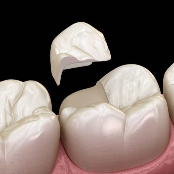 dental bonding in vancouver