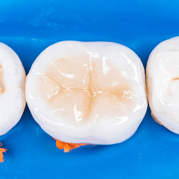 dental fillings in vancouver