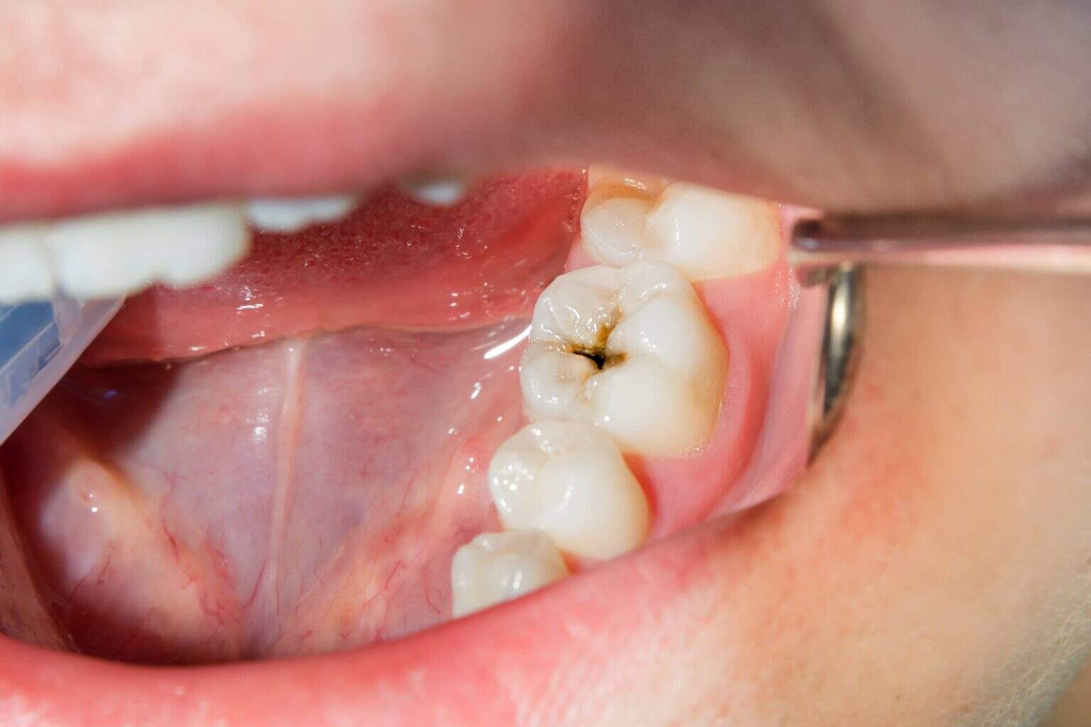 dental fillings near me