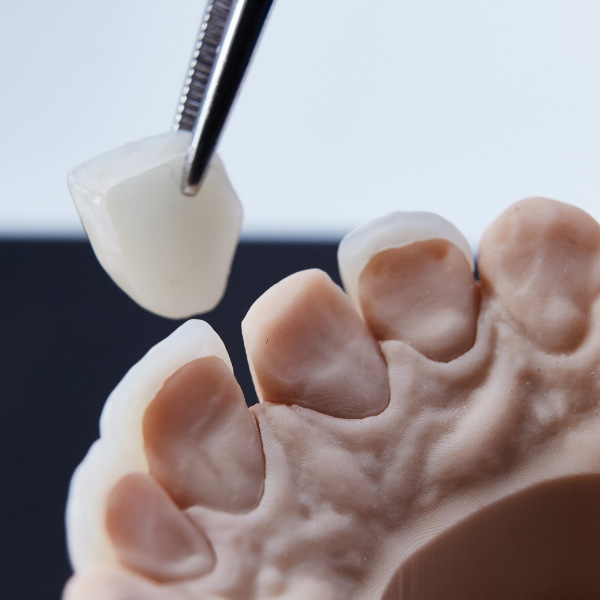 porcelain veneers in vancouver
