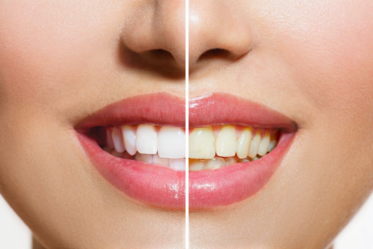 can yellow teeth be white again