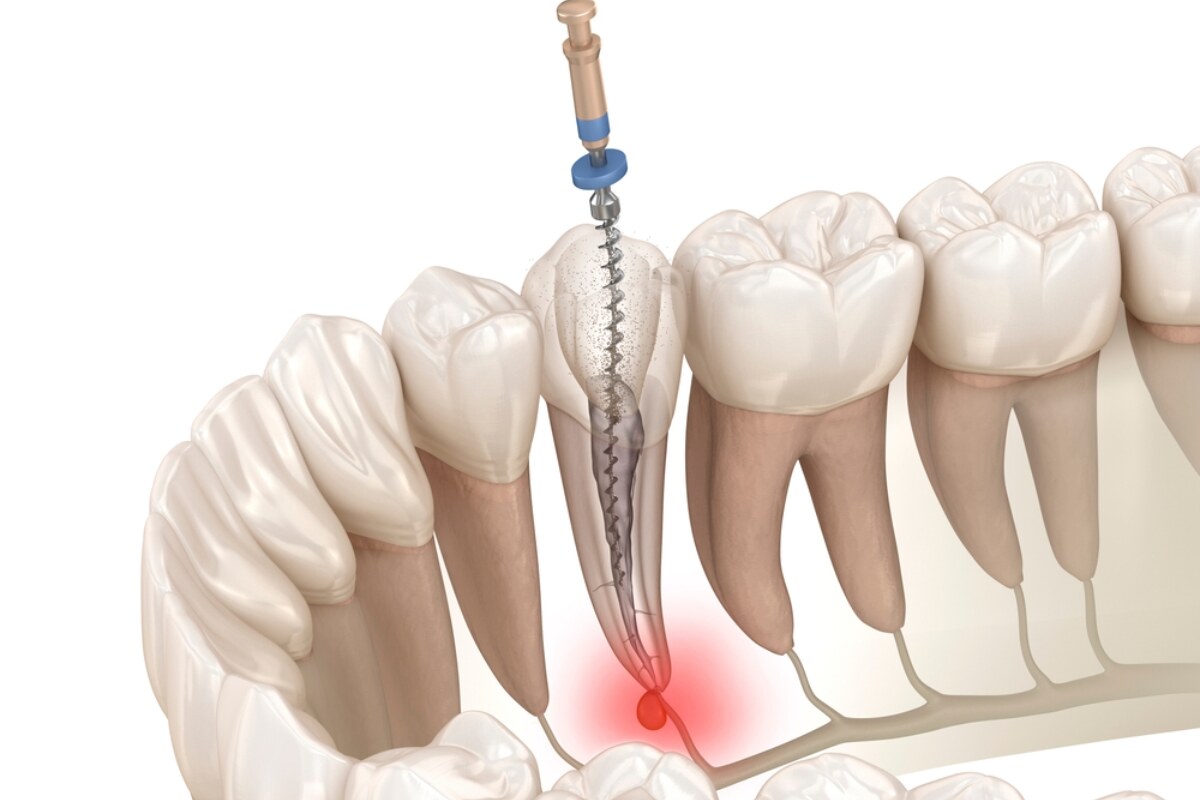 why root canal treatment is important for oral health