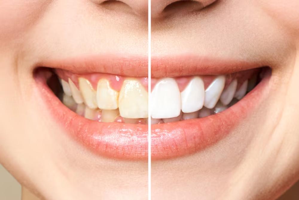 before-and-after-teeth-whitening-results