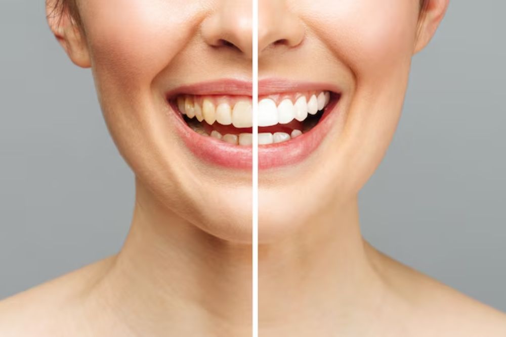 teeth whitening treatment for stained or yellow teeth